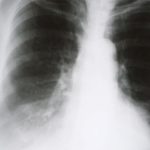 Whole Body Vibration as Alternative to Exercise for Patients with COPD 56