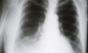 Whole Body Vibration as Alternative to Exercise for Patients with COPD 56