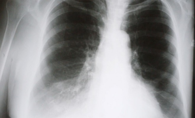 Whole Body Vibration as Alternative to Exercise for Patients with COPD 1