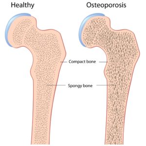Early Signs of Osteoporosis in Women 53