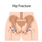 Can WBV Speed Fracture Recovery? 52