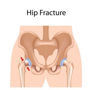 Can WBV Speed Fracture Recovery? 52