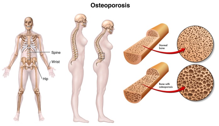 Early Signs of Osteoporosis in Women 2