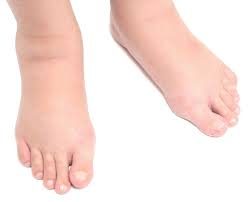 Why Your Feet and Ankles Swell 26