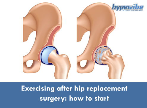 hip replacement surgery exercise