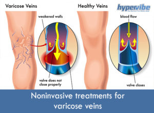 Noninvasive treatments for varicose veins 15