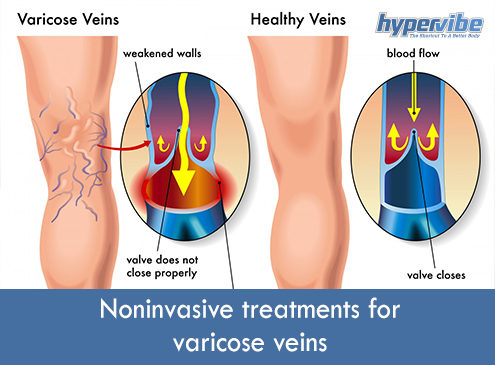 Noninvasive treatments for varicose veins 2