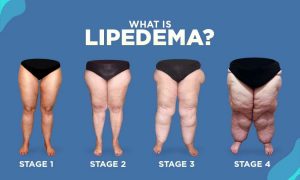 How to Use a Vibration Plate for Lipedema