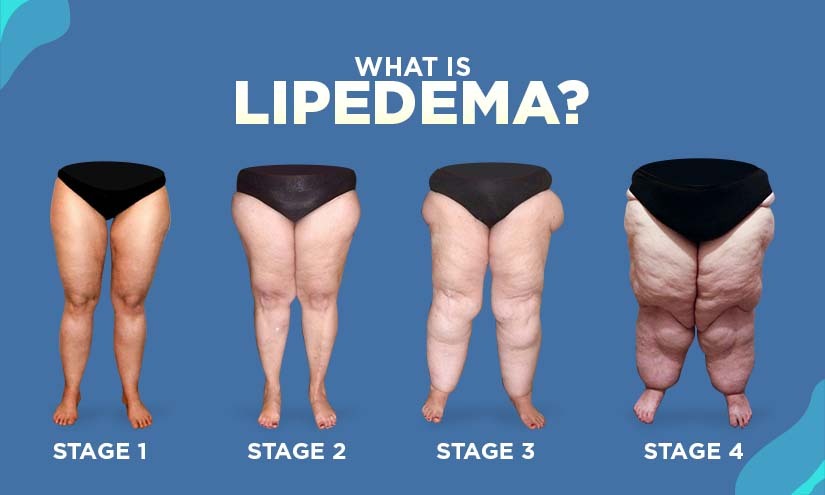 How to Use a Vibration Plate for Lipedema