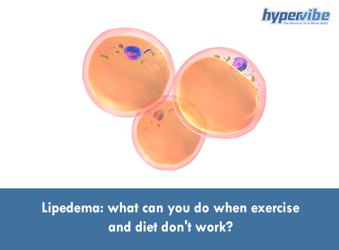 Lipedema: What Can You Do When Exercise and Diet Don't Work? 2