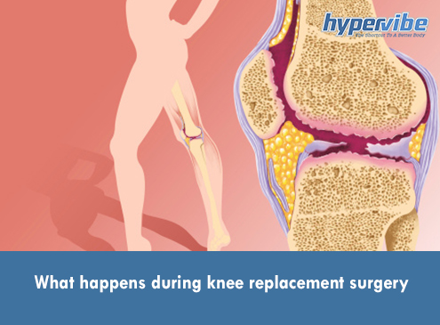 What happens during knee replacement surgery