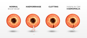 Haemophilia
