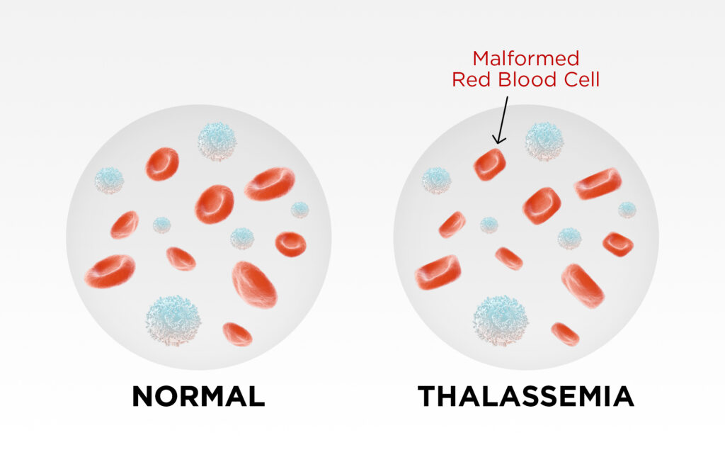 Thalassaemia & Whole Body Vibration - The State of the Research 5