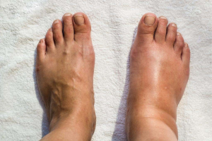 swelling in lymphedema and lipedema