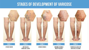 Stages of Varicose Vains