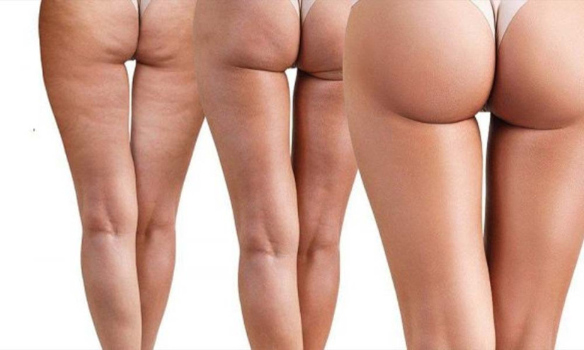 how to manage cellulite