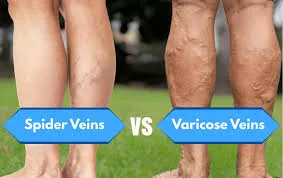 image of legs with varicose veins and spider veins image of legs with varicose veins and spider veins