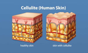 what is cellulite