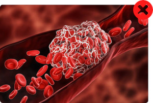 lymphatic massage dangers - blood clot