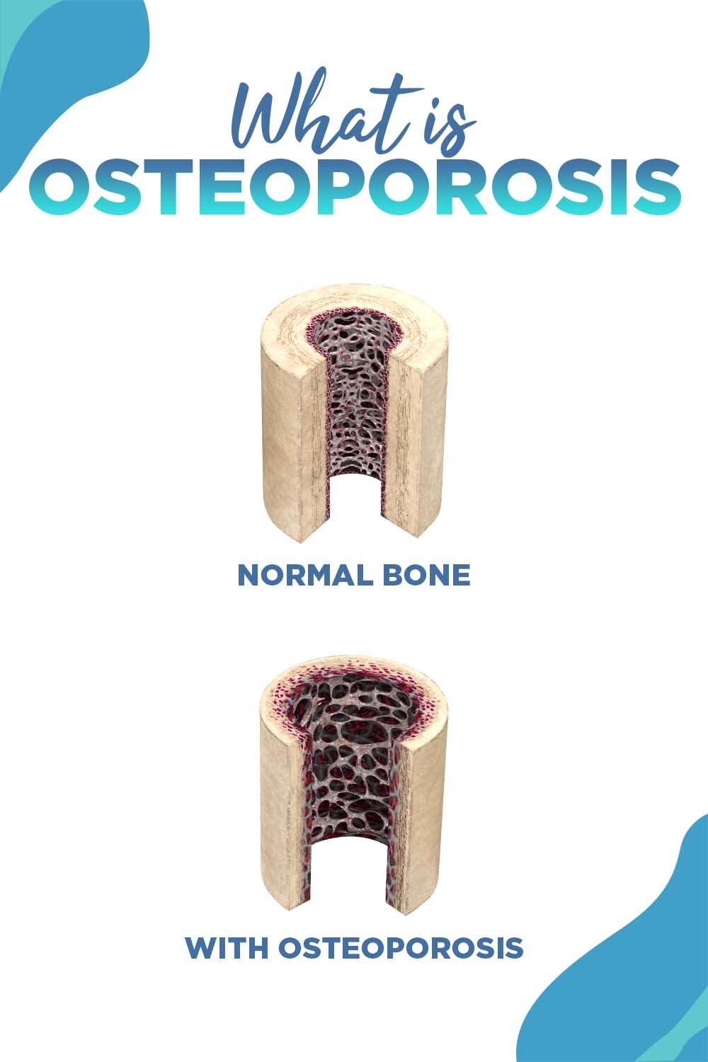 vibration plate for osteoporosis