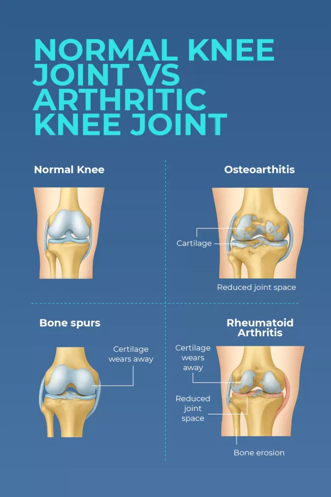 Infographic comparing a normal knee joint with osteoarthritis and rheumatoid arthritis, showing cartilage loss, reduced joint space, bone spurs, and bone erosion.
