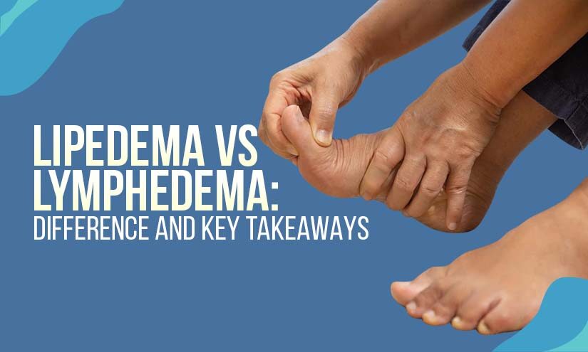 lipedema vs lymphedema